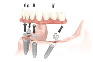 All-on-4 Treatment Concept diagram
